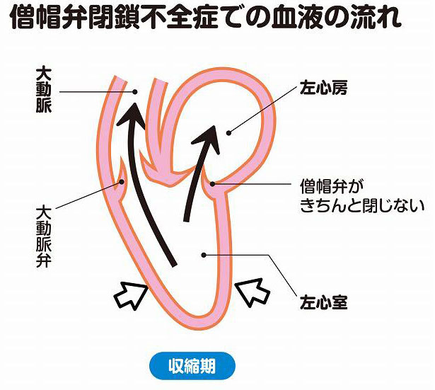 僧帽弁閉鎖不全症での血液の流れ