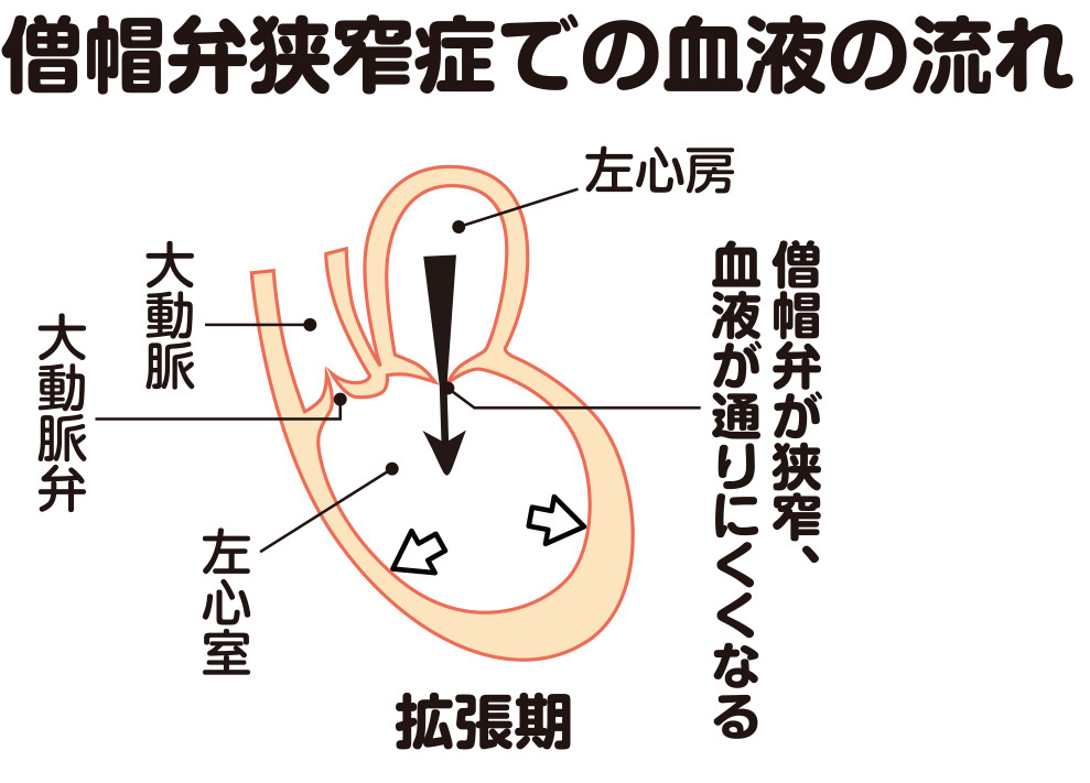 僧帽弁狭窄症での血液の流れ