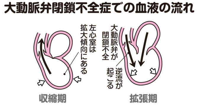 大動脈弁閉鎖不全症での血液の流れ
