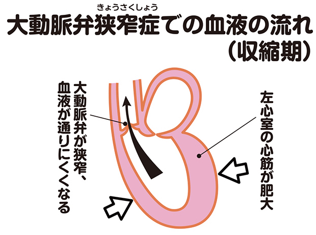 大動脈弁狭窄症での血液の流れ