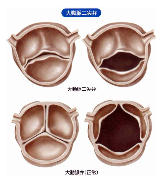 大動脈二尖弁