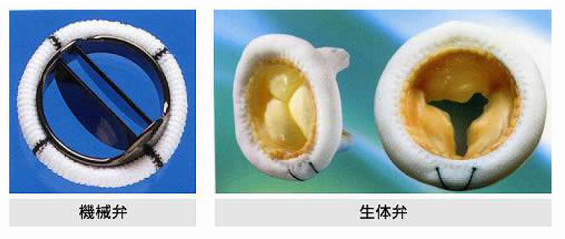 機械弁・生体弁