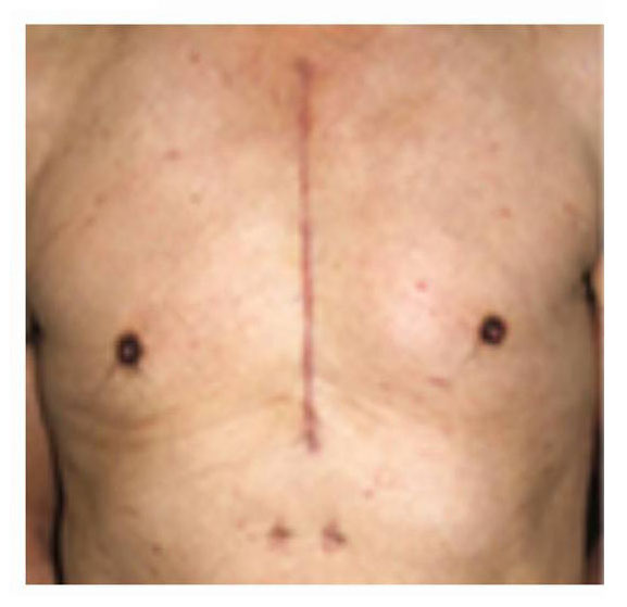 胸骨正中切開の傷跡