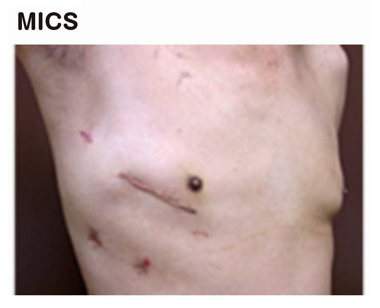 ミックスの傷跡