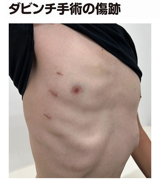 ダビンチ手術の傷跡