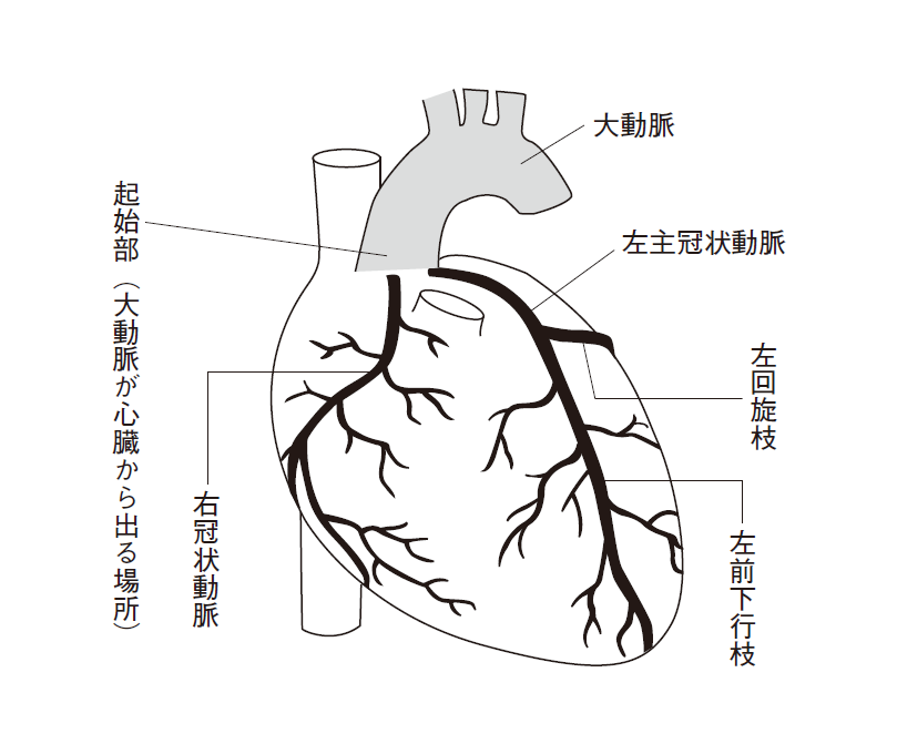 心筋梗塞とは