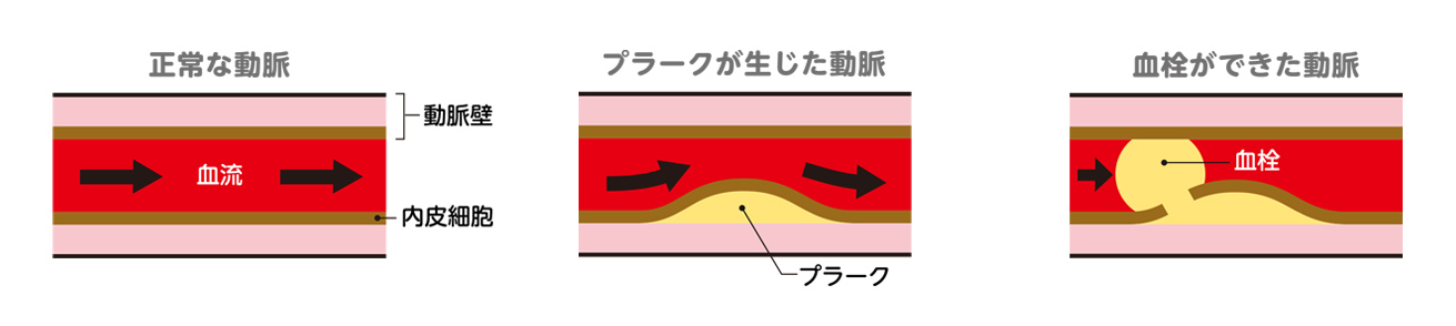 心筋梗塞・狭心症の原因