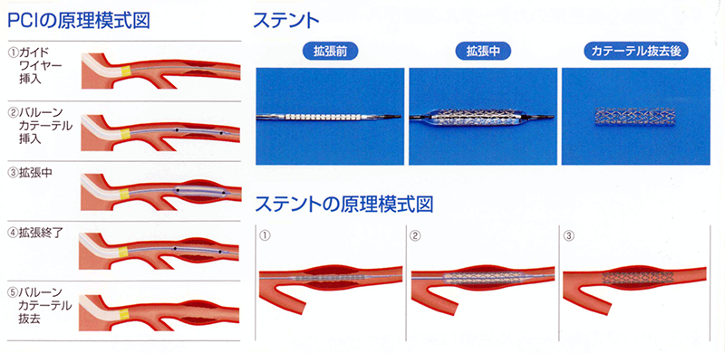 PCIの原理模式図