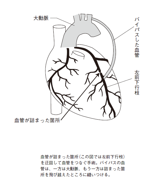 冠動脈バイパス手術
