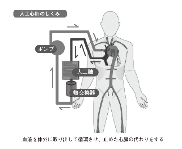人工心肺のしくみ