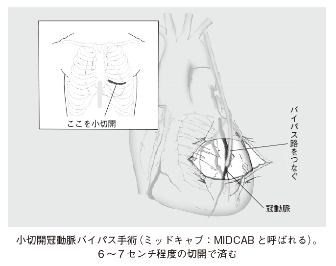小切開CABG1