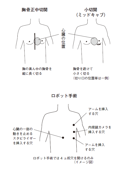 小切開CABG2