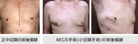 MICS（低侵襲心臓手術・小切開心臓手術）の術後傷跡
